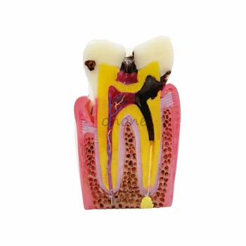 Proteza Zob Model 6X Karies Primerjavi Model, Zobno Gnilobo Model,Zobozdravnik za Medicinske Znanosti Poučevanje